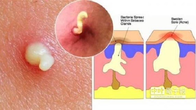 擠痘痘擠了這麼多年 你知道那白白的東西 Iqueen愛女人購物網